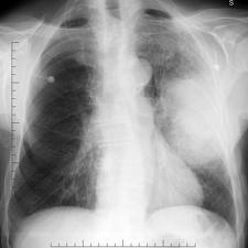 Bronchogenic-carcinoma-x-ray.jpg