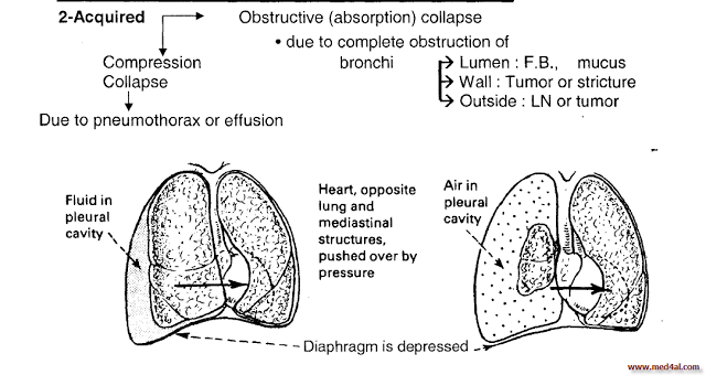 causes-of-lung-collapse.png