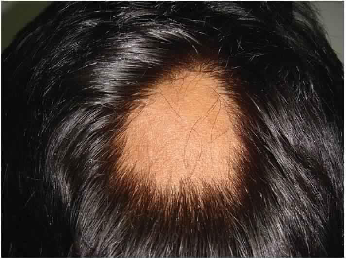 119-085349-causes-symptoms-alopecia-treatment-2.jpg