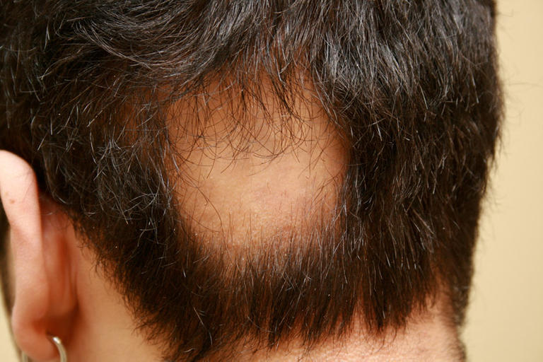 119-085350-causes-symptoms-alopecia-treatment-4.jpg