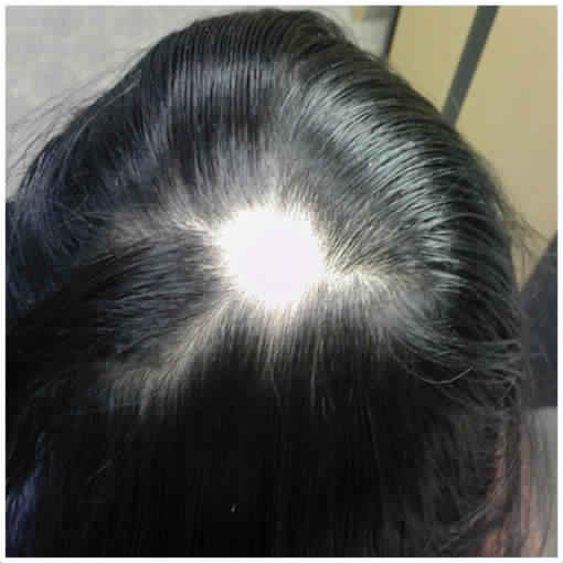 119-085350-causes-symptoms-alopecia-treatment-5.jpg